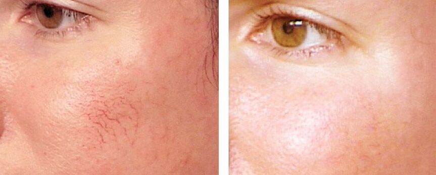 Rosacea eltávolítása